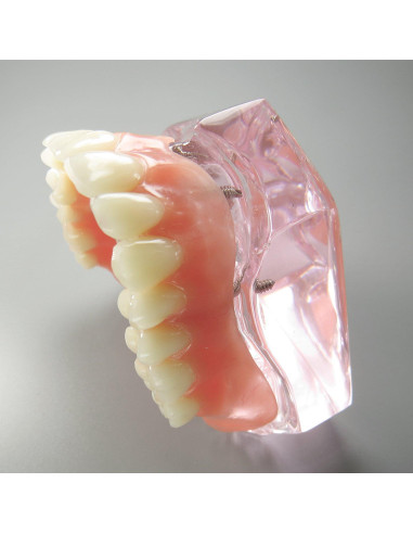 Modelo Dental Sobredentadura Superior Smile1000 4 Implantes