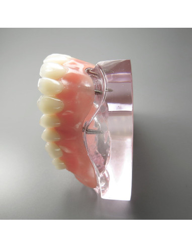 Modelo Dental Sobredentadura Superior Smile1000 4 Implantes