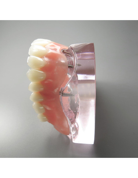 Modelo Dental Sobredentadura Superior Smile1000 4 Implantes