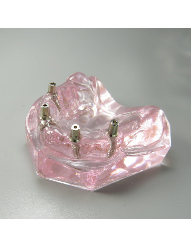 Modelo Dental Sobredentadura Superior Smile1000 4 Implantes