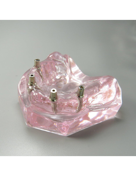 Modelo Dental Sobredentadura Superior Smile1000 4 Implantes