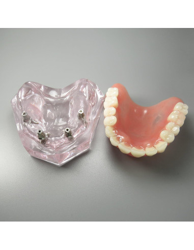 Modelo Dental Sobredentadura Superior Smile1000 4 Implantes