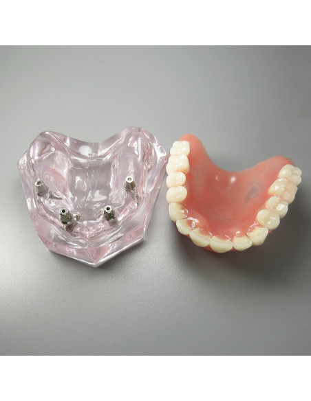 Modelo Dental Sobredentadura Superior Smile1000 4 Implantes