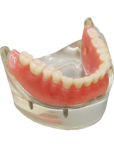 Modelo Dental Sobredentadura Inferior Smile1000 4 Implantes 2