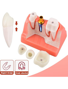 Modelo de Implante Dental Ultrassist 4X con Corona y Puente 2