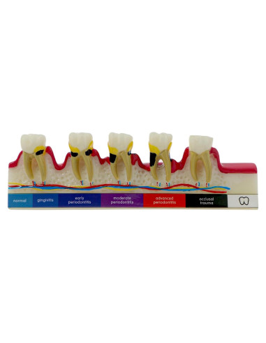 Modelo Dental 6 Etapas Enfermedad Periodontal Sprucedent