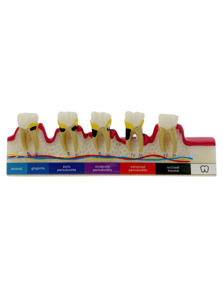 Modelo Dental 6 Etapas Enfermedad Periodontal Sprucedent