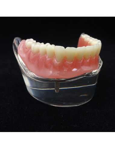 Modelo Dental Sobredentadura Inferior Smile1000 2 Implantes