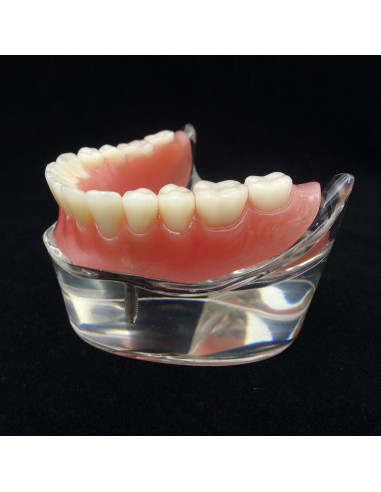 Modelo Dental Sobredentadura Inferior Smile1000 2 Implantes