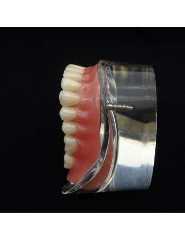 Modelo Dental Sobredentadura Inferior Smile1000 2 Implantes