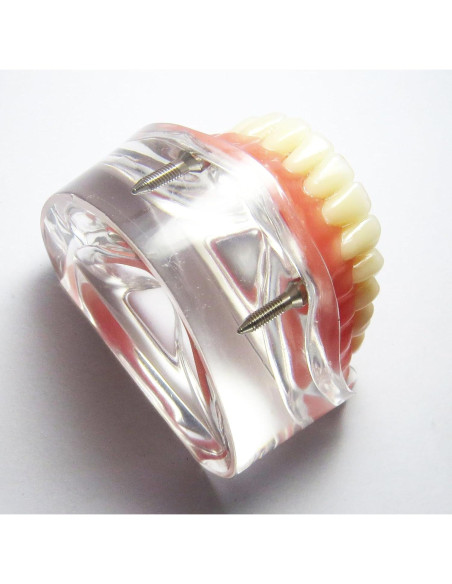 Modelo Dental Sobredentadura Inferior Smile1000 2 Implantes