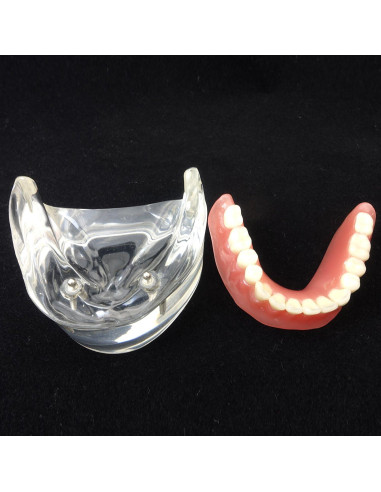 Modelo Dental Sobredentadura Inferior Smile1000 2 Implantes