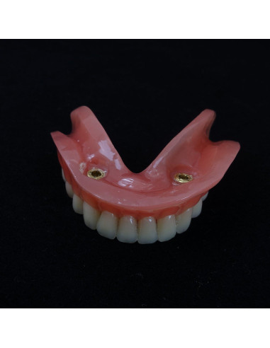 Modelo Dental Sobredentadura Inferior Smile1000 2 Implantes