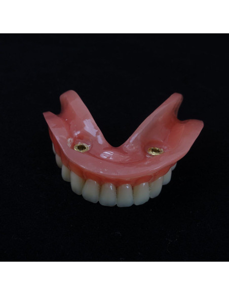 Modelo Dental Sobredentadura Inferior Smile1000 2 Implantes