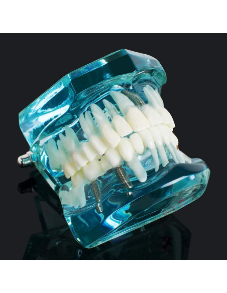 Modelo de Implante Dental Typodont Azul Transparente