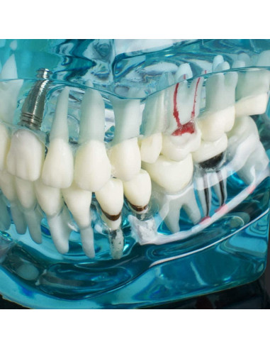 Modelo de Implante Dental Typodont Azul Transparente