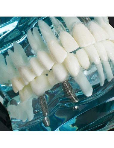 Modelo de Implante Dental Typodont Azul Transparente