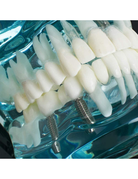 Modelo de Implante Dental Typodont Azul Transparente