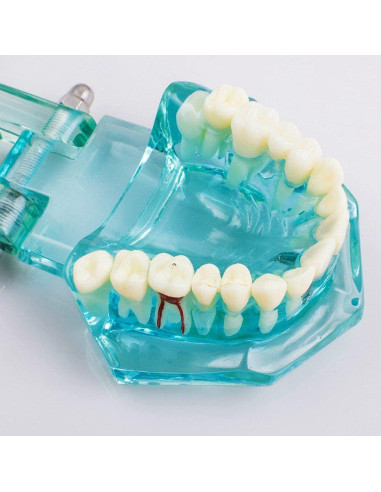 Modelo de Implante Dental Typodont Azul Transparente