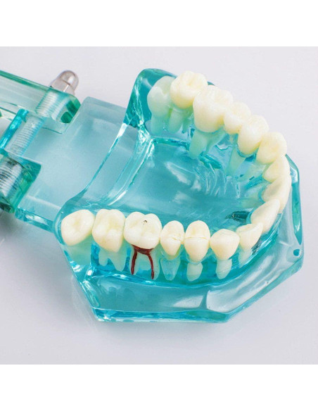 Modelo de Implante Dental Typodont Azul Transparente