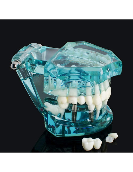 Modelo de Implante Dental Typodont Azul Transparente