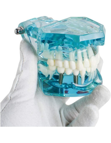 Modelo de Implante Dental Typodont Azul Transparente