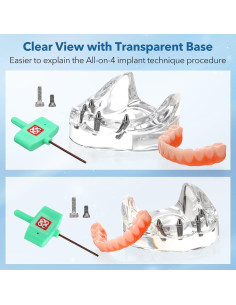 Implante Dental All-on-4 Guangzhou con Corona Removible 2