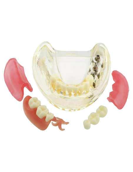 Modelo Dientes de Implante Pinnasilxm M6006 Puente Inferior 3 Implantes