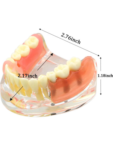 Modelo Dientes de Implante Pinnasilxm M6006 Puente Inferior 3 Implantes