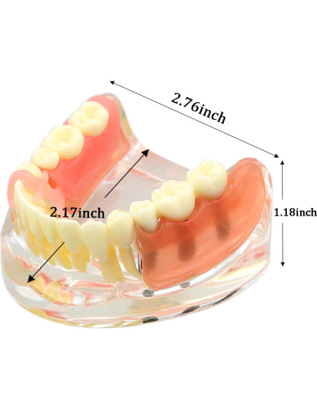 Modelo Dientes de Implante Pinnasilxm M6006 Puente Inferior 3 Implantes