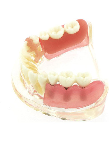 Modelo Dientes de Implante Pinnasilxm M6006 Puente Inferior 3 Implantes