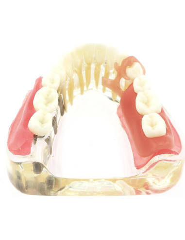 Modelo Dientes de Implante Pinnasilxm M6006 Puente Inferior 3 Implantes