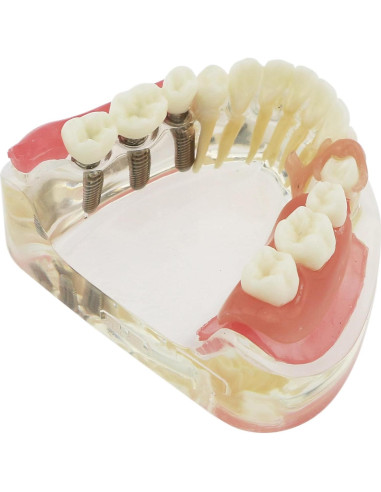 Modelo Dientes de Implante Pinnasilxm M6006 Puente Inferior 3 Implantes