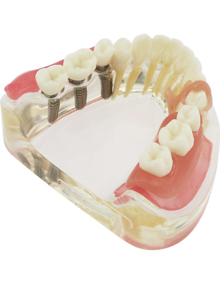 Modelo Dientes de Implante Pinnasilxm M6006 Puente Inferior 3 Implantes