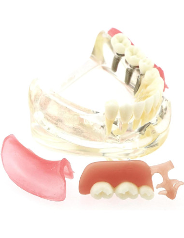Modelo Dientes de Implante Pinnasilxm M6006 Puente Inferior 3 Implantes