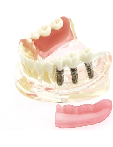 Modelo Dientes de Implante Pinnasilxm M6006 Puente Inferior 3 Implantes