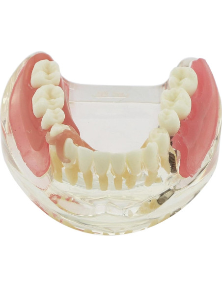 Modelo Dientes de Implante Pinnasilxm M6006 Puente Inferior 3 Implantes