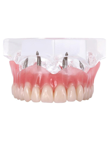 Modelo de Implantes Dentales Sobredentadura XINGXING M6001C