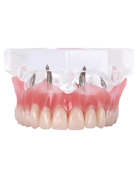 Modelo de Implantes Dentales Sobredentadura XINGXING M6001C