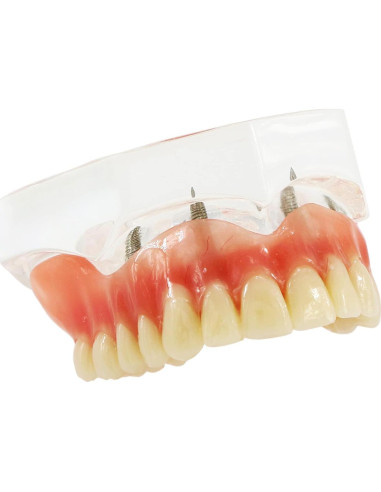 Modelo de Implantes Dentales Sobredentadura XINGXING M6001C