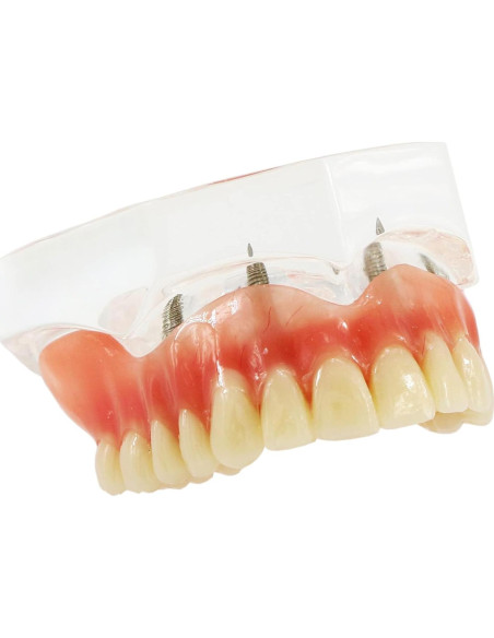 Modelo de Implantes Dentales Sobredentadura XINGXING M6001C