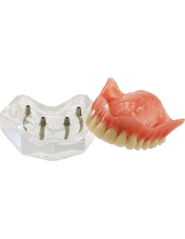 Modelo de Implantes Dentales Sobredentadura XINGXING M6001C