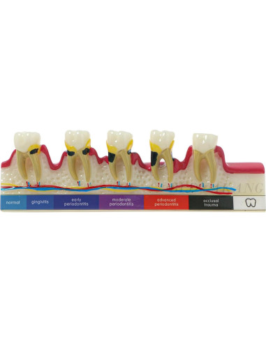 Modelo Dental Periodontal BLDYAKANG para Educación Oral