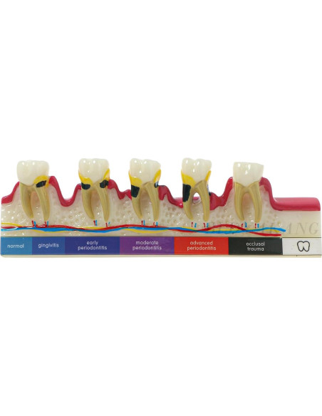 Modelo Dental Periodontal BLDYAKANG para Educación Oral