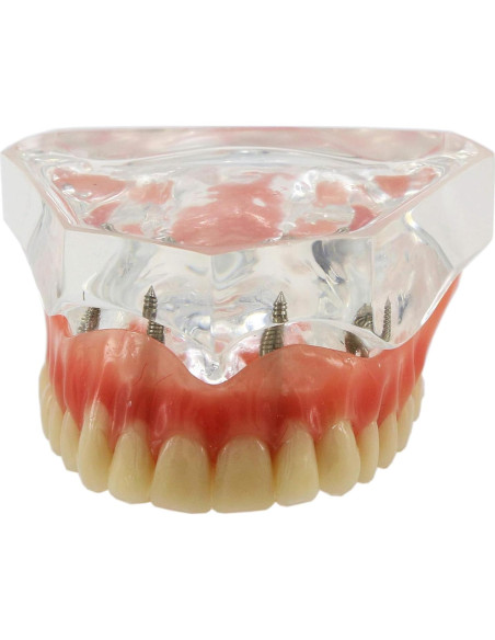 Modelo de Implantes Dentales Sobredentadura XINGXING M6001C