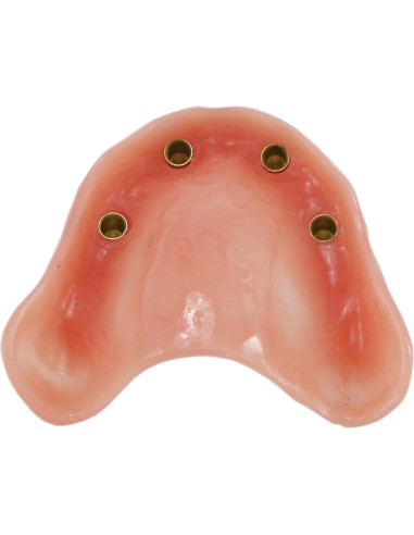 Modelo de Implantes Dentales Sobredentadura XINGXING M6001C