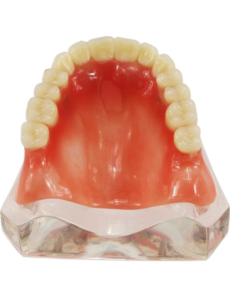 Modelo de Implantes Dentales Sobredentadura XINGXING M6001C