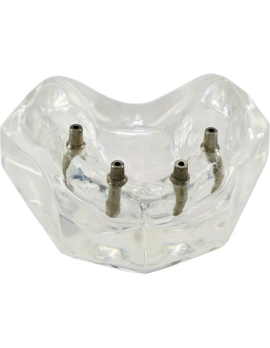 Modelo de Implantes Dentales Sobredentadura XINGXING M6001C