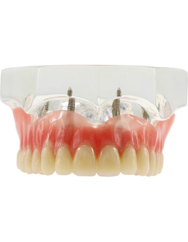 Modelo de Implantes Dentales Sobredentadura XINGXING M6001C