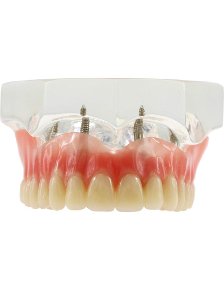Modelo de Implantes Dentales Sobredentadura XINGXING M6001C